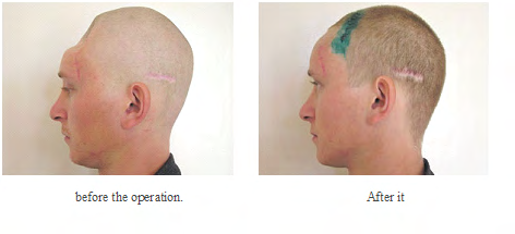 Figure 2: Demonstrate the Litar Application in the Restored Bone Tissue.