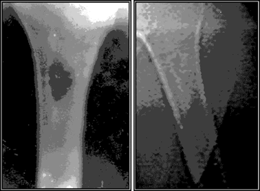 Figure 4: Patient M’s X-ray before filling in the defect and 4 months after the operation. On the defect spot, one can barely see the unclear blur of the restored bone tissue.