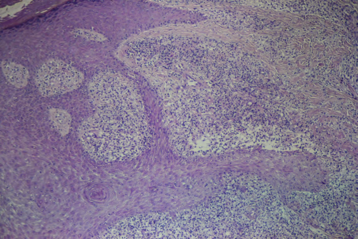Figure 1: a: Pea-sized umbilicated lesion. b: Transepidermal elimination of lepromatous granuloma (HE × 100).