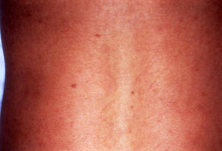 Figure 4: a: Nerve biopsy (HE × 100). Severely infiltrated lymphocytes, neutrophils, epithelioid cells as well as thickened perineurium are seen. b: Fite stain × 400. Vacuolated spaces are stuffed with massive degenerated AFB.