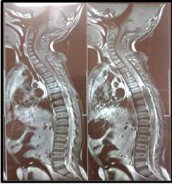 Figure 1: Spine MRI significant cystic syringohydromyelia along the dorso-lumber spine from the D8 to L1 vertebrae effacing the extradural space at this level measuring 9.7cm x 1.1cm in cranio-caudal and transverse diameters respectively.