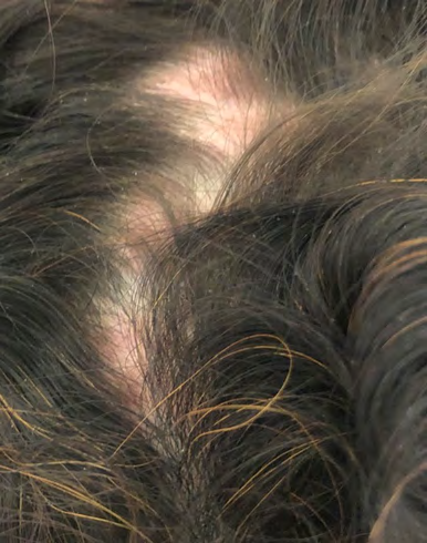 Figure 1: Clinical picture of cicatricial and non-cicatricial alopecia of the scalp.