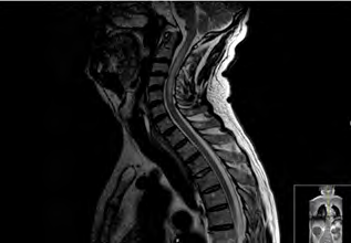 Figure 1: MRI Cervical Medulla: Hyperintense Lesions in T2, C2-C6 region.