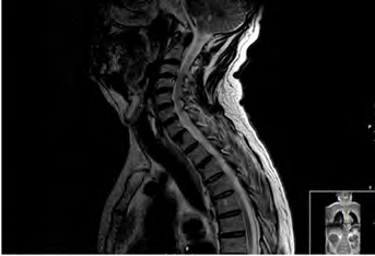 Figure 2: MRI Cervical Medulla (paramagnetic contrast): medular hypercaptation, elongated shape, affecting the left lateral spinal cord in C2-C3.