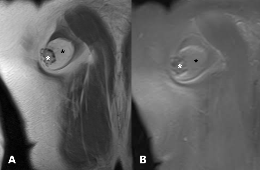 Figure 3: MRI: A) Axial T2 weighted, Expansive formation with high signal intensity (black asterisk) similar to subcutaneous fat and bone scoring in the inferior angle of the right scapula (white asterisk). The bone lesion presents continuity with the bone marrow of the scapula and a thin border of the low signal intensity being able to corresponds the cartilage layer, indicating a probable osteochondroma, B) Axial STIR. The fatty lesion presents suppression of the signal, characterizing lipomatous tissue (black asterist). Note that there is a linear hypersignal area at the anterior border of the bone lesion (white arrow), which corresponds to a probable hemorrhagic component secondary to the previous percutaneous biopsy procedure, C) Axial T1 weighted after administration of gadolinium. Note the fine area of the interface between the fatty and bony component, indicating that it is border of fibrous tissue (black arrow).