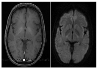 Figure 2: Abnormal symmetrical T1 hyperintense signal in bilateral globus pallidus showing no diffusion restriction. Findings are suggestive of chronic hepatic encephalopathy.
