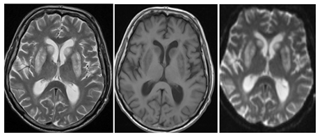 Figure 3: Symmetrical abnormal signals involving bilateral basalganglia, appearing hypointense on T1 and hyperintense on T2 sequence and showing restricted diffusion on DWI.