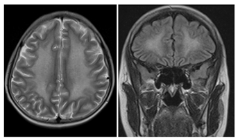 Figure 5: Symmetrical abnormal T2 and FLAIR hyperintense signals in centrum semiovale and eriventricular white matter likely representing chemotherapy induced white matter disease.