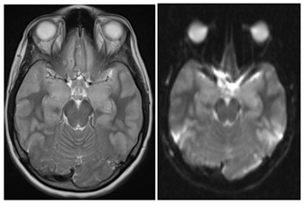 Figure 7: Diffuse T2 hyperintense signals in cortical and subcortical locations more severe in the mesial temporal lobes and hippocampi associated with gyral swelling. These are showing diffusion restriction.