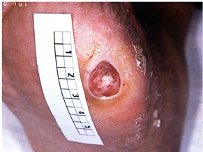 Figure 1: Courtesy reference number 87-Typical diabetic ulceration at stage 2 (Wagner/Amstrong classification) seen at typical predisposed location of metatarsal 1. The shape is typically circular and surrounded by a hyperkeratotic border. Modest erythema of the surrounding tissue suggests coinfection (if verified, stage 2b criteria are fulfilled).