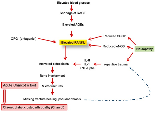 Figure 2: Courtesy ref no.87- Pathophysiology of diabetic osteoarthropathy underlying the central role of the RANKL-OPG system in the development of destructive bone alterations. RANKL= receptor activator of nuclear factor-kappa B ligand; AGE = advanced glycation end product; CGRP= calcitonin gene-related peptide; eNOS= endothelial nitric oxide synthase; IL= interleukin; OPG= osteoprotegerin; RAGE= receptor for advanced glycation end products; TNF= tumor necrosis factor.