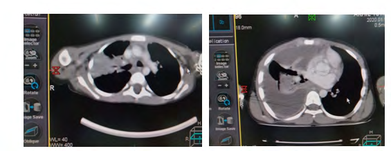 Figure 2: Showing the consolidation and effusion of right lung.