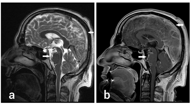 Figure 2: MRI Brain; Midline Sagittal T2 (a) and Post contrast T1 (b) section show diffuse pial collateral venous channels predominantly in the pre-pontine cistern, there is Superior Sagittal sinus thrombosis seen as loss of normal flow void (a) and filling defects (b).