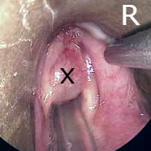 Figure 1: Intra – operative picture of the left vocal fold cystic lesion (X).