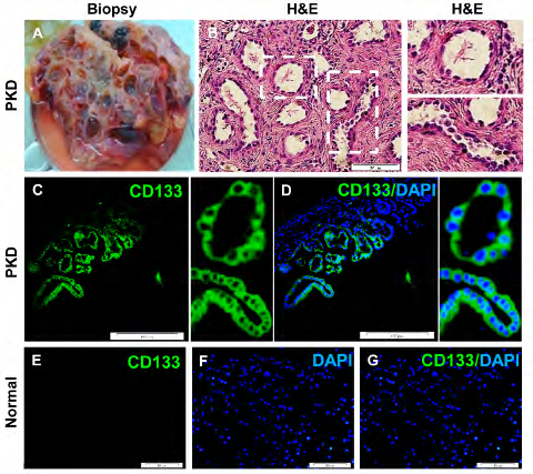 Figure 1: Histological evaluation of PKD and normal kidney tissues. A: PKD tissue biopsy, B: H&E staining for PKD tissues, C & D: CD133 expression in polycystic-lining cells, E & G: normal kidney tubular cells without CD133 expression.