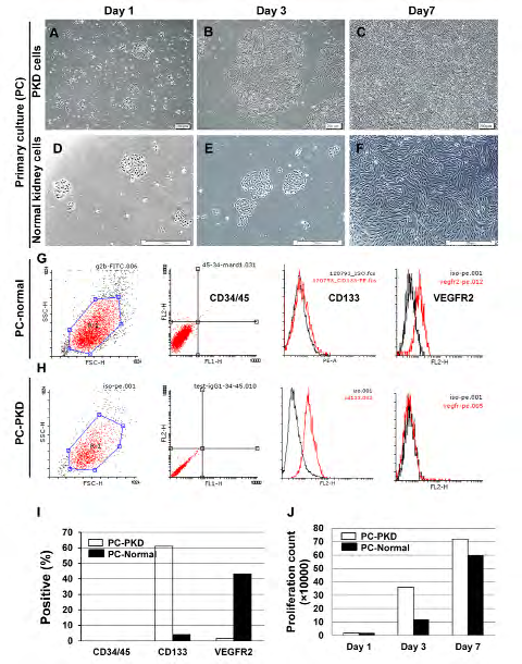 Figure 2: Polycystic CD133+ renal progenitor cells proliferation in culture. A-F: Colony formation and expansion of PKD and normal cells after 7 days. G-I: Cells isolated from PKD were proliferative and expressed CD133 in comparison with normal cells. However, the endothelial marker VEGFR2 was not expressed by PKD cells, but expressed by normal cells. Haematopoietic markers CD45 and CD34 were absent in both of them. J: Proliferative count showed that PKD cells had a higher proliferative potential compared to normal cells.