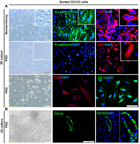 Figure 3: Sorted polycystic CD133+ renal progenitor cells with low adherent junctions’ expression. A: Sorted polycystic and normal CD133+ renal progenitor cells were positive for CK8. However, sorted polycystic CD133+ renal progenitor cells were negative for E-cadherin. ZO-1 was expressed at low levels in sorted polycystic CD133+ renal progenitor cells. But, normal CD133 progenitor cells were positive for E-cadherin and ZO-1. B: Sorted polycystic CD133+ renal progenitor cells were positive for CD133 marker in 3D culture on collagen type I.