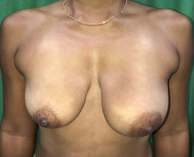 Figure 1: Asymmetry of the left breast.