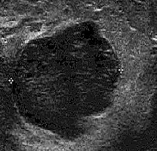 Figure 2: Breast ultrasound suggestive of lipoma.