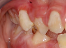 Figure 2: Hyperplastic gingivitis.