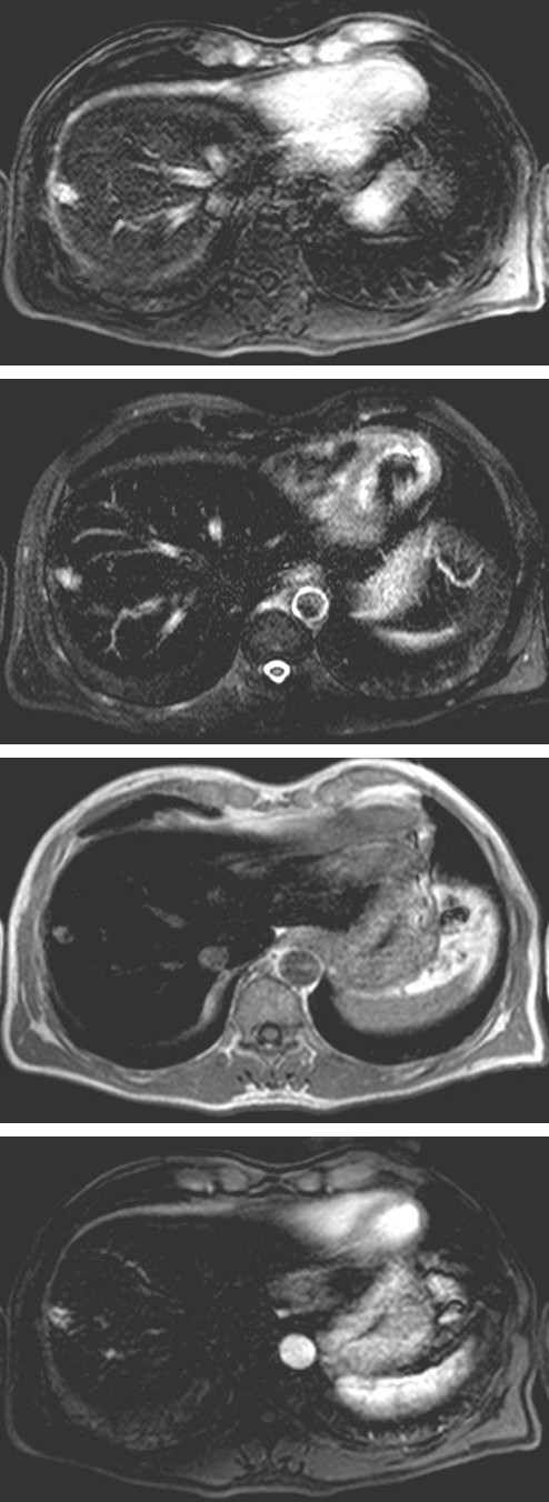 Figure 1: Magnetic resonance (MR) of upper abdomen. Section passing trought the hepatocellular carcinoma in VIIs. Top left: hepatobiliary phase. Top right: fat suppressed phase. Down left: T1 weighted. Down right: T1 post contrast early arterial phase.