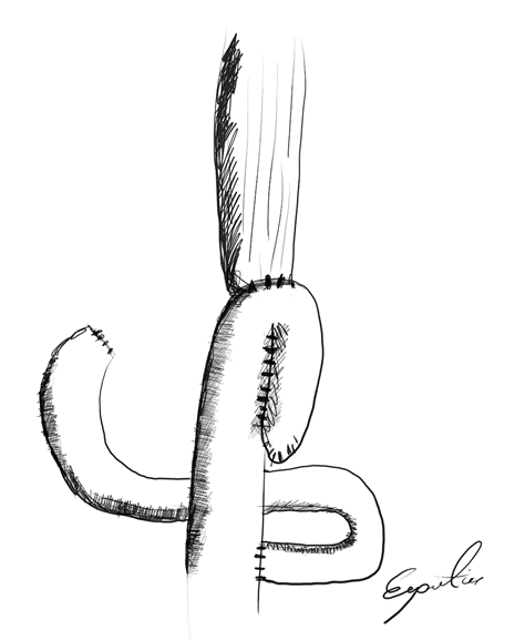 Figure 3: Multiple aberrant branches of the left gastric artery.