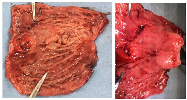 Figure 5: Multifocal lesions in stomach with bleeding stigma.