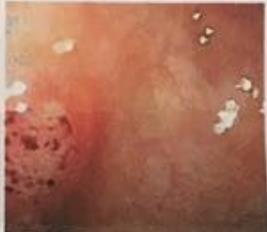 Figure 6: Rectal hemangioma.