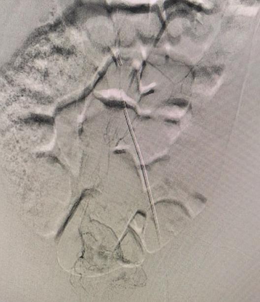 Figure 7: Rectal angiodysplasia fed by the superior hemorrhoidal artery.