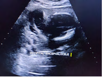 Figure 1: Occipital encephaloele.