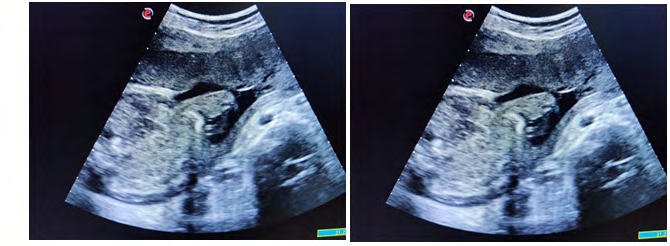 Figure 3: Omphalocele.