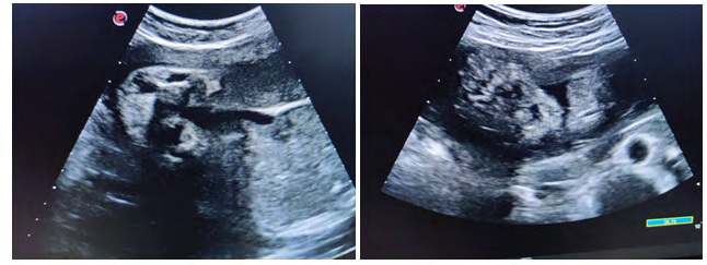 Figure 4: Mesomelia (short limbs) Talipes and Polydactyly.