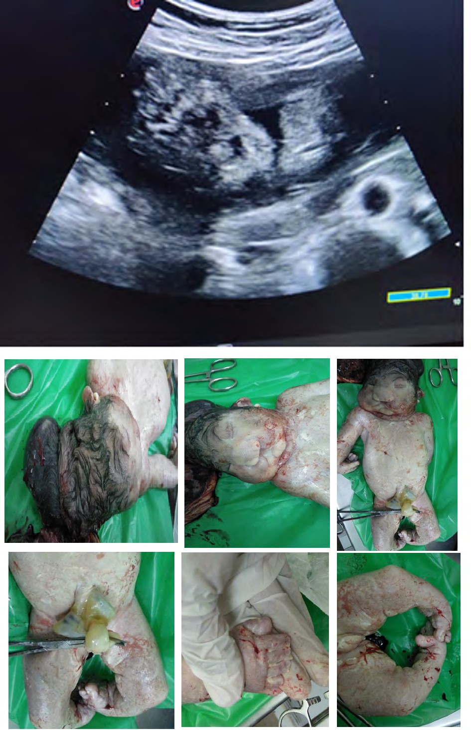 Figure 5: Cleft lips.