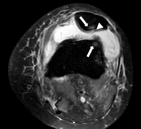 Figure 2: Cross ligament injury; 2a: Sagittal section in PD with evidence of alteration of the two cruciate ligaments (arrows); 2b: Coronal cut in PD fat saturation, with evidence of impaired insertion of both cruciate ligaments and meniscal extrusion (arrows).