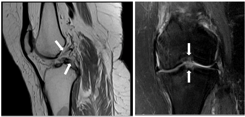 Figure 3: Patellar subluxation with femoral chondropathy, Axial section in PD with fatty saturation, with the presence of joint effusion (black arrow), patellar subluxation and chondropathy in the femoral condyle (white arrows).