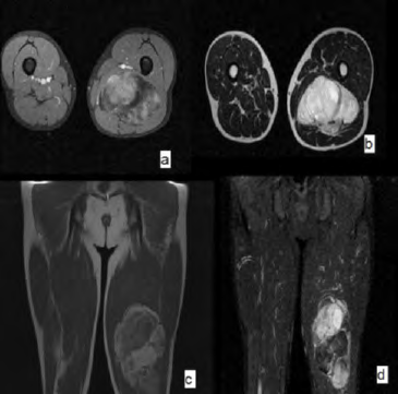 Figure 12: MRI of the left thigh in section (a) coronal T1 C+ (b) coronal T2 (c) sagittal T1 (d) sagittal C+ FATSAT showing the presence of a voluminous mass of the lower half of the posterior compartment of the left thigh appearing to develop intermuscularly at the dependency of the semimembranous muscle and the well limited biceps femoral measuring 165x68x155mm with polylobate partitioned contours. This mass is tissue containing a fat contingent and necrotic areas.