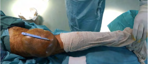 Figure 2: Sarcoma located at the popliteal fossa.