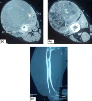 Figure 8: Scanning sections (a) and (b) axial and (c) frontal showing a well circumscribed, heterogeneously enhanced, hyper- vascularized (section of vessels within the mass) and calcification process of the anterior compartment of the right thigh. Compact periosteal reaction causing cortical thickening.