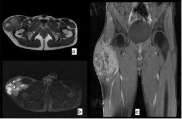 Figure 9: MRI of the right thigh in sections (a) coronal T1 (b) coronal T2 FAT SAT (c) sagittal T1 C+ showing the presence at the vastus lateralis of the right quadricipital muscle of a heterogeneous polylobed mass, containing tissue areas described as discrete hyposignal T1 hypersignal T2 and other haemorrhagic areas as hypersignal T1, hypersignal T2 not disappearing on the FATSAT sequence. It measures: 11x10x10 cm in diameter. Topographically: it infiltrates adjacent muscles in contact with the femoral neck diaphysis, without lysis or bone signal abnormalities.