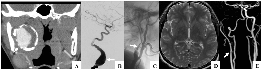 Figure 1: Young patient with large partially thrombosed and calcified, likely chronic dissecting, aneurysm of the right cervical ICA seen on CTA (A); DSA done during PAO procedure shows the large fusiform aneurysm (B) treated with PAO using Amplatzer plugs (arrows) in the proximal ICA (C); MRI of brain on follow-up did not reveal any intracranial ischemic lesion (D) and continued occlusion of the aneurysm (E).