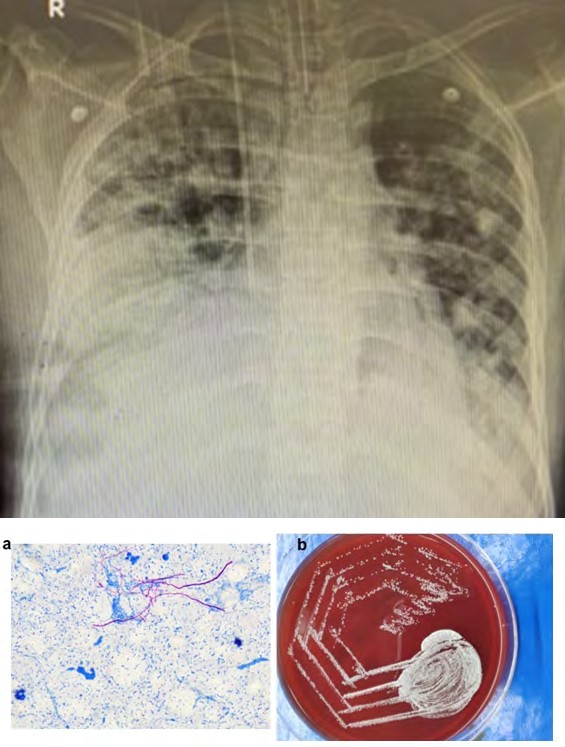 Figure 1: ** Chest X-ray AP view showing bilateral lung infiltrate with lower lung zone consolidation.
