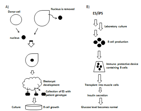 Figure 1: Current approaches of Hyperglycemia treatment using stem cells. A) Therapeutic cloning approach; B) ES/ iPS Stem cell, therapy.