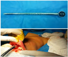 Figure 1: The cervix dilator size (8/11) used as a blunt tissue dilator passing through the vestibular incision to create a single subplatysmal tunnel.