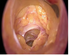 Figure 4: visual confirmation of the tube placement in the desired location in the subplatysmal tunnel.