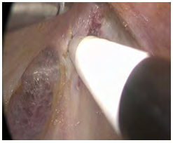 Figure 5: Additional sharp dissection with an energy device or hook cautery was performed to extend the subplatysmal space to the desired borders.