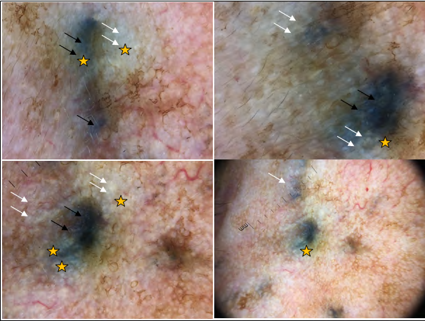 Figure 2: Dermoscopy shows a homogeneous grayish-blue pigment (dark narrows), shiny white areas, grayish-white blotches and strands (white narrows) which formed grayish-white veil (yellow stars).