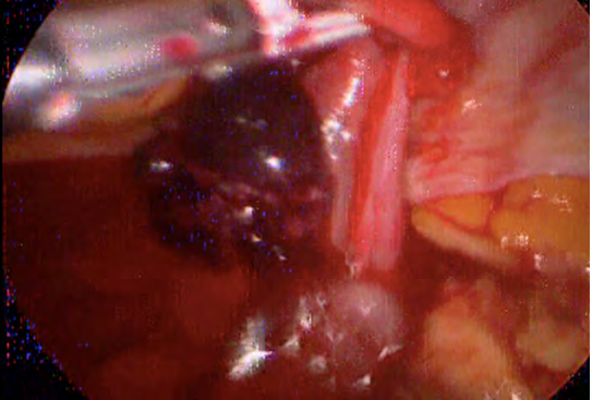 Figure 2: Left ruptured Ectopic pregnancy.
