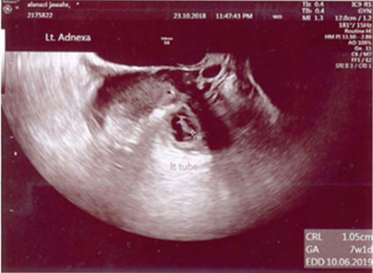 Figure 3: Rt Alive Ectopic pregnancy corresponding to 7 weeks.