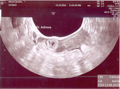 Figure 4: Left Alive Ectopic corresponding with 6 weeks + 5 days.