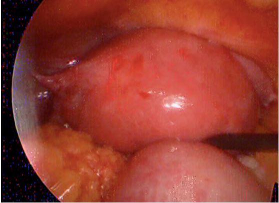 Figure 5: Uterus after bilateral salpingectomy Intra operatively, abdominal cavity was found full of clotted blood. Bilateral salpingectomy done using Ligasure. Blood was suctioned and port closed. Patient tolerated the procedure well and had uncomplicated inpatient hospital course and OPD follow up afterwards.